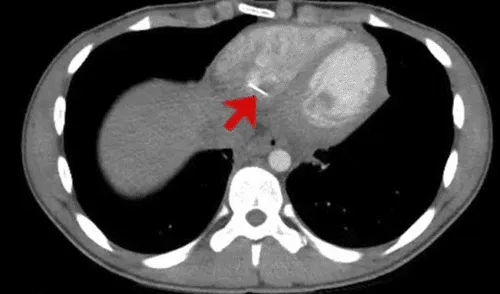 EE.UU.: adolescente acude al hospital por dolor en el pecho y descubren que tiene un alfiler en el corazón