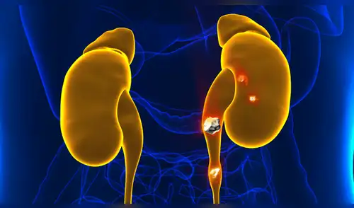 Cálculos Renales. ¿Cuáles son los síntomas y tratamientos?