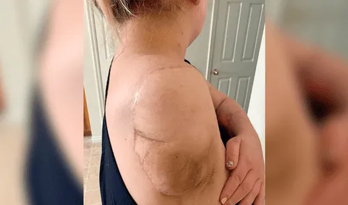 Mujer de 26 años perdió el brazo y estuvo once días en coma por una bacteria carnívora 