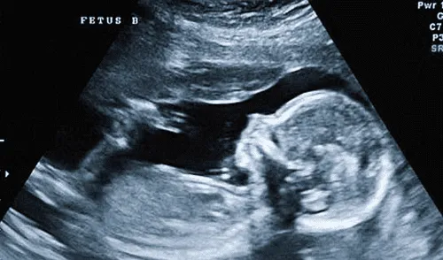 Youtube: bebé de 28 semanas “saluda” a sus padres en una ecografía