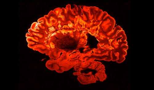 Los periodos largos de vigilia podrían causar que el cerebro humano elimine por su propia cuenta una cantidad significativa de neuronas. Foto: referencial / Govind Bhagavatheeshwaran / Daniel Reich / National Institute of Neurological Disorders and Stroke / National Institutes of Health (NIH) Cerebro