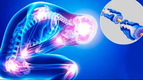 Síndrome de Guillain Barré: ¿Cómo prevenir avance de esta enfermedad?