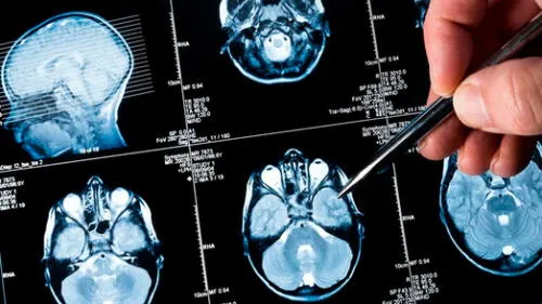 Niña salva de morir luego de que tumor cerebral que tenía desapareció inexplicablemente