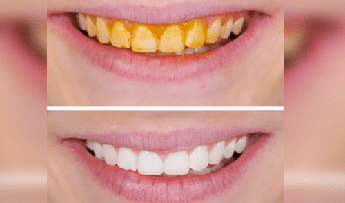 YouTube: conoce cómo blanquear tus dientes en tan solo 5 minutos [VIDEO] 