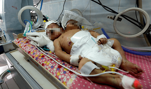 Bebés siameses mueren en Yemen al no recibir tratamiento [VIDEO]