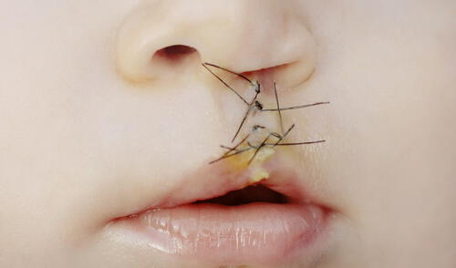Labio leporino: causas, factores de riesgo y tratamiento