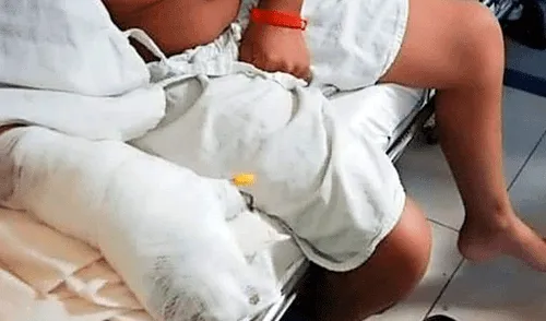 Niños resultaron quemados.