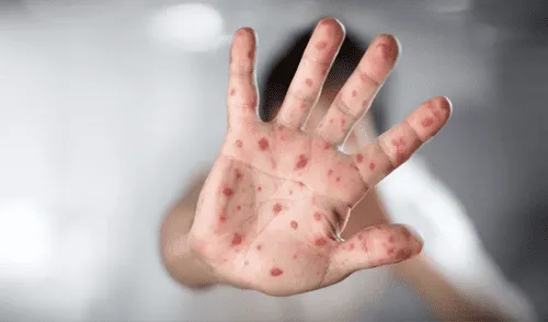 El sarampión es uno de los virus humanos más contagiosos del mundo, pero se puede prevenir casi por completo mediante la vacunación. Foto: La República El sarampión es uno de los virus humanos más contagiosos del mundo, pero se puede prevenir casi por completo mediante la vacunación. Foto: La República