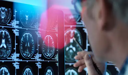 Los problemas neurológicos no serían raros en pacientes con COVID-19, dijo el PhD. Majid Fotuhi | Foto: APA