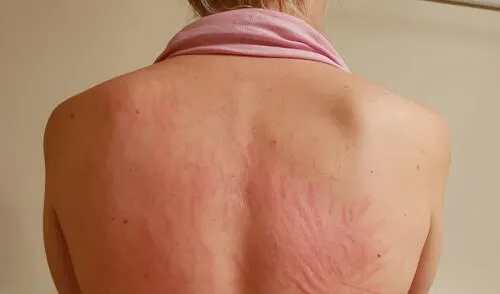 Las erupciones de urticaria normalmente se presentan en estadíos tempranos de la COVID-19, aunque se pueden extender por semanas. Foto: Covidskinsigns Las erupciones de urticaria normalmente se presentan en estadíos tempranos de la COVID-19, aunque se pueden extender por semanas. Foto: Covidskinsigns
