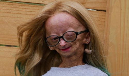 Adalia Rose falleció a los 15 años. Foto: Instagram