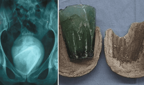 Imagen del objeto alojado dentro de la vejiga de la paciente. Foto: composición/ScienceDirect