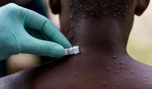 Personal de salud extrae muestra de lesión cutánea en un joven sospechoso de estar infectado con la viruela del mono. Foto: The Washington Post