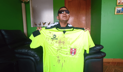 El árbitro fue diagnosticado con un traumatismo, hematoma y edema macular. Foto: Alexander Flores / URPI-LR El árbitro fue diagnosticado con un traumatismo, hematoma y edema macular. Foto: Alexander Flores / URPI-LR