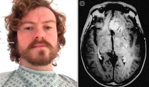 Gracias a una resonancia magnética, Iain pudo descubrir que padecía de cáncer en etapa 3. Foto: Mirror Gracias a una resonancia magnética, Iain pudo descubrir que padecía de cáncer en etapa 3. Foto: Mirror