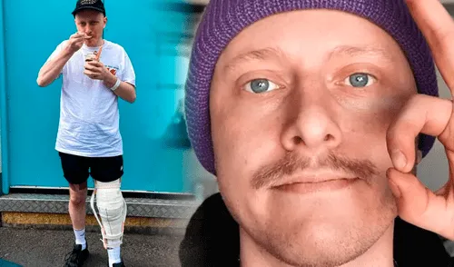 El hombre tuvo que someterse a 6 cirugías durante las 6 semanas que estuvo en el hospital por la rara y potencial mortal enfermedad. Foto: BBC