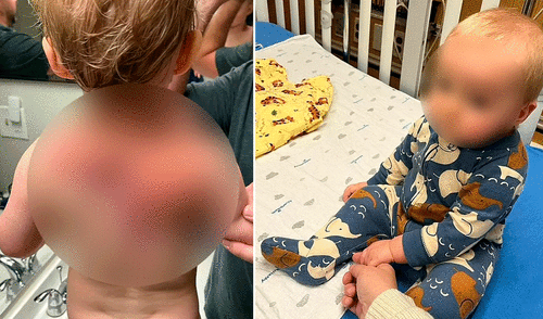 "Tuvimos que dormirlo de lado porque no podía apoyar la cabeza", señaló la madre de J. M.