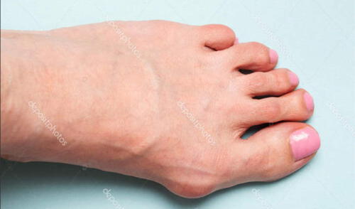 En los pies suelen aparecer juanetes y estas son las causas. Foto: Depositphotos ¿Qué son los juanetes en el pie y cómo evitar que aparezcan?