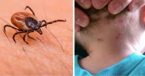 La rickettsiosis viene siendo una infección fatal para México en tiempos calurosos. Foto: composición LR/El Financiero/Reporte Indigo Niño de 4 años muere tras contraer enfermedad letal por picadura de garrapata en México