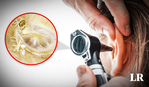 El arácnido vivía en su oído interno y había mudado de piel. Foto: composición de Jazmin Ceras / NEJM