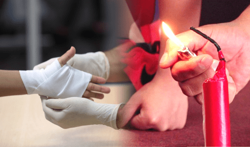 El uso de pirotécnicos puede causar quemaduras en cualquier parte del cuerpo. Foto: composición LR/Andina/difusión quemaduras en la mano y pirotécnicos