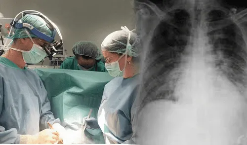 Los cirujanos cardíacos infantiles del Chuac realzaron una reversión de cardiopatía fulminante en una niña