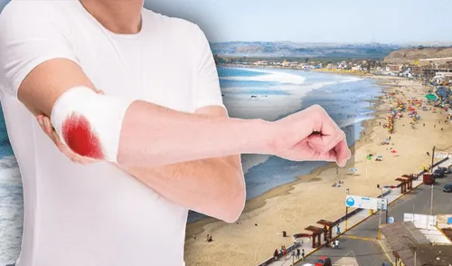 Averigua qué suceden con tus vacaciones si eres trabajador formal y tienes un accidente. Foto: composición LR/Andina playa de Lima y persona accidentada