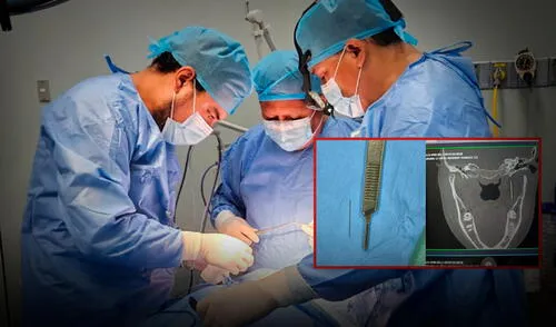 Pese a la complejidad de la situación, la operación resultó siendo todo un éxito y se pudo retirar la pieza dental. Foto: Composición LR Pese a la complejidad de la situación, la operación resultó siendo todo un éxito y se pudo retirar la pieza dental. Foto: Composición LR