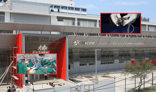 Primera vez que el Perú realiza un transplante de corazón artificial