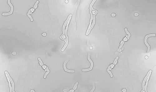 Las miodesopsias, también conocidas como moscas volantes, son acumulaciones de colágeno que se forman en el humor vítreo del ojo.