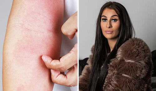 Joven con alergia al agua revela que solo puede ducharse dos veces por semana: "La lluvia puede ser muy dolorosa"