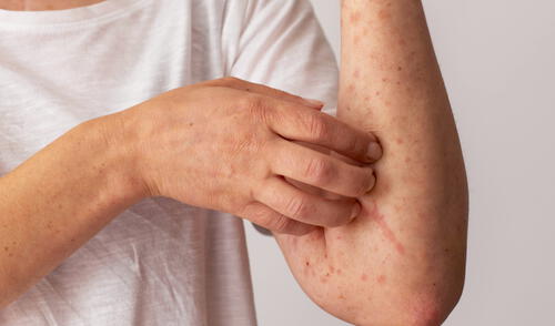 Estados Unidos ha reportado más de 800 casos en 2025. Otros estados, como Indiana y Michigan, también enfrentan brotes vinculados al resurgimiento en Texas. Foto: Freepik