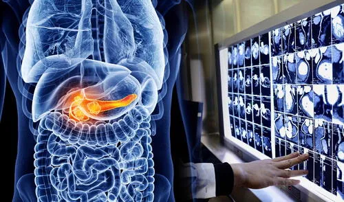Científicos chinos logran detectar cáncer de páncreas con inteligencia artificial y recibe aprobación de la FDA