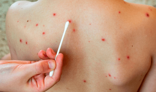 Las cifras de la enfermedad y los recientes fallecimientos, dejan entrever la baja cifra de vacunación en el país. Foto: Aula de la farmacia