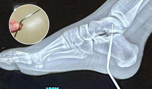 La niña, de tan solo 12 años, sufrió un accidente al clavarse una aguja de crochet de 10 cm en el pie, lo que dejó asombrados a médicos y familiares. Foto: composición LR La niña, de tan solo 12 años, sufrió un accidente al clavarse una aguja de crochet de 10 cm en el pie, lo que dejó asombrados a médicos y familiares.