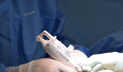 El implante se insertó mediante un procedimiento mínimamente invasivo que duró unos 10 minutos y utilizó anestesia local.