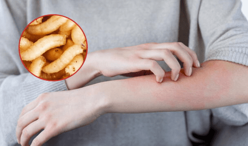 La enfermedad parasitaria resurge y pone en alerta a las autoridades sanitarias mexicanas.