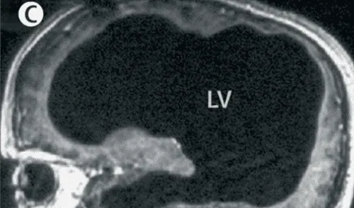 Diagnosticado desde la infancia, el paciente ha mantenido su independencia y una vida normal, a pesar de su condición neurológica extrema. Foto: The Lancet
