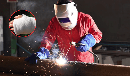 Soldador se fractura la mano trabajando en EEUU. Soldador se fractura la mano trabajando en EEUU.