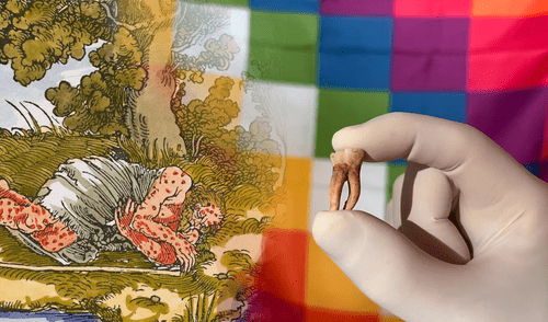 Lepra, América, Europa