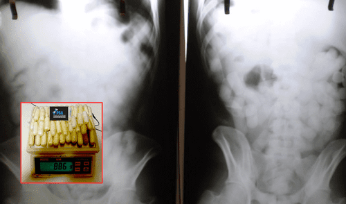 Este caso resalta los riesgos extremos que algunos individuos asumen al participar en el tráfico internacional de drogas. Foto: composición LR/Clarín/Policía de Seguridad Aeroportuaria Este caso resalta los riesgos extremos que algunos individuos asumen al participar en el tráfico internacional de drogas. Foto: composición LR/Clarín/Policía de Seguridad Aeroportuaria