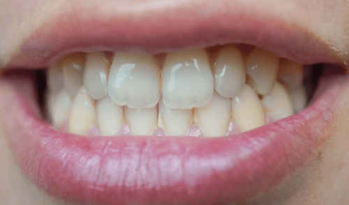 Esta bebida contiene vitamina C, vitamina E y compuestos fenólicos que ayuda a los dientes Esta bebida contiene vitamina C, vitamina E y compuestos fenólicos que ayuda a quitar el sarro de los dientes Foto: iStock