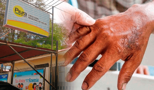 Detectan caso de lepra en Piura. Foto: composición LR