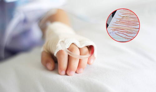 Extirpan 142 lombrices del estómago a niño de 7 años en México.