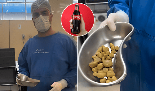 Plato con 35 cálculos extraídos tras años de consumo excesivo de gaseosas. Foto: @aapayes Plato con 35 cálculos extraídos tras años de consumo excesivo de gaseosas.
