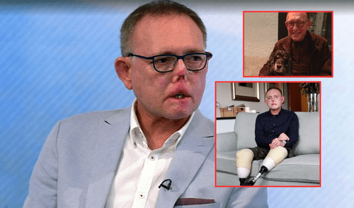 El caso de Jaco Nel, el hombre que perdió piernas, dedos y parte de su cara por lamida y arañazo de su perro