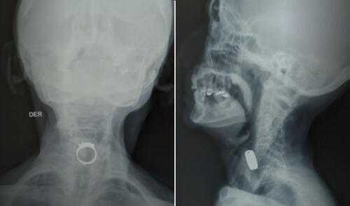 Mujer de 85 años comió un anillo mientras dormía: soñó que era caramelo y terminó internada en hospital de Lima. Foto: composición LR/RPP. Mujer come anillo | perú | lima | hospital arzobispo loayza | mujer sueña que come caramelo y come anillo