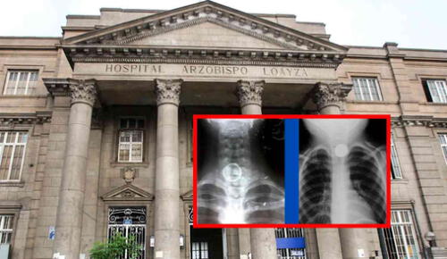 La anciana pasó por evaluación de los servicios de Otorrinolaringología y Gastroenterología del Hospital Loayza, lo que ayudó a su recuperación. Anciana en hospital arzobispo loayza