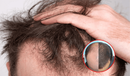 Estudios confirman que finasterida y minoxidil son efectivos en casos de alopecia avanzada.
