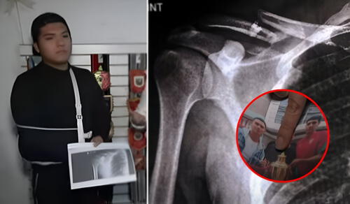 Renzo Santos fue agredido por tres individuos, quienes le rompieron la clavícula. Foto: Composición LR